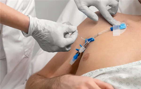 FlexGRIP CVC 4,5-9 Fr bez podkovy, Hydrocolloid(pro centrální katétry)